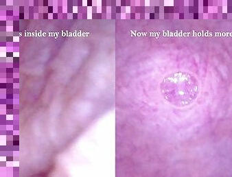 POV Endoscope Catheter Bladder Inflation - Preview